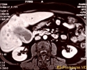Μαγνητική τομογραφία σε ασθενή με καρκίνο της χοληδόχου κύστης. Φαίνεται η επέκταση της νόσου στο ηπ