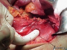Esophageal Stapling UGI bleed_2
