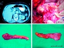 Cystic pancreatic tumors