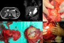 Cystic pancreatic tumors