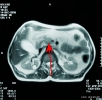 Pancreatic Cancer details