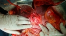 total-pancreatectomy