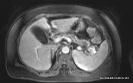 total-pancreatectomy