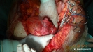 Redo sarcoma lower pelvis