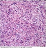 Σαρκώματα μαλακών μορίων οπισθοπεριτοναϊκού χώρου (retroperitoneal soft tissue sarcomas)_11