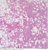 Σαρκώματα μαλακών μορίων οπισθοπεριτοναϊκού χώρου (retroperitoneal soft tissue sarcomas)_8